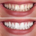 What is the Average Cost of Teeth Whitening at a Dentist's Office in Nashville, TN?