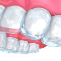 Where to Find the Best Invisalign® Treatment in Nashville, TN