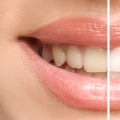 Achieve a Radiant Smile with Teeth Whitening Treatments in Nashville, TN