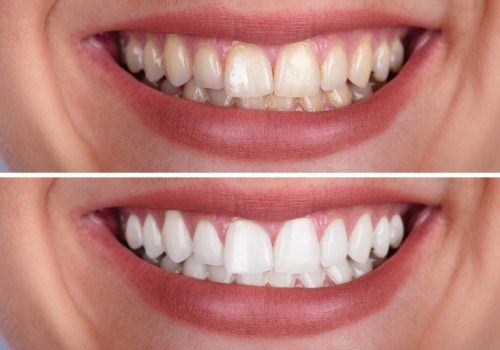 What is the Average Cost of Teeth Whitening at a Dentist's Office in Nashville, TN?