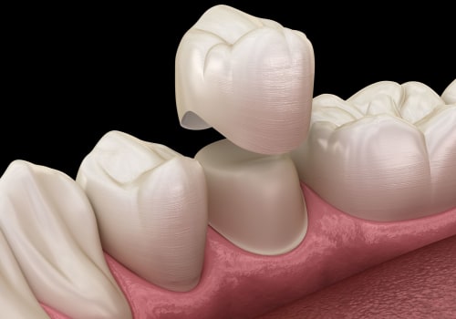 What is the Average Cost of a Root Canal in Nashville, TN?